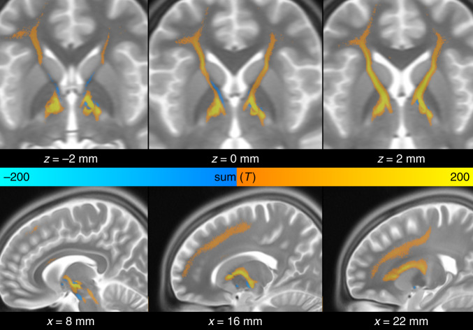 A unified connectomic target for deep brain stimulation in obsessive-compulsive disorder