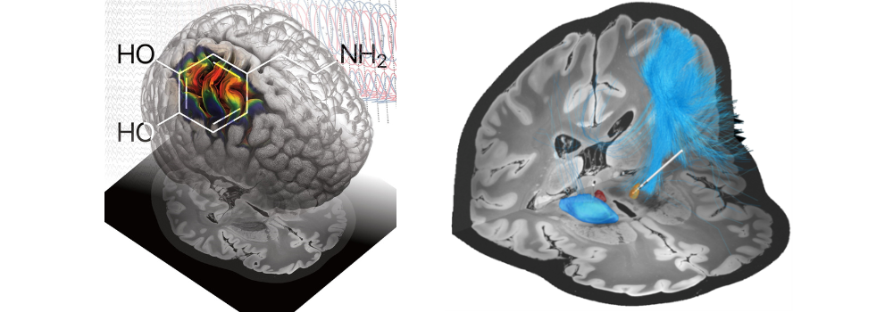 Parkinson's: Deep Brain Stimulation can mimic dopamine effect